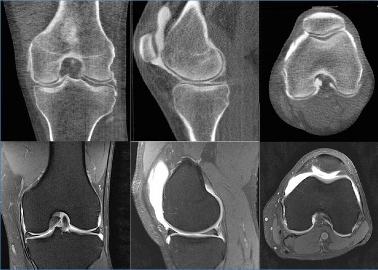 Mustár térd artrózisával térd osteoarthrosis kezelése modern mágneses lézeres terápiás eszközökkel